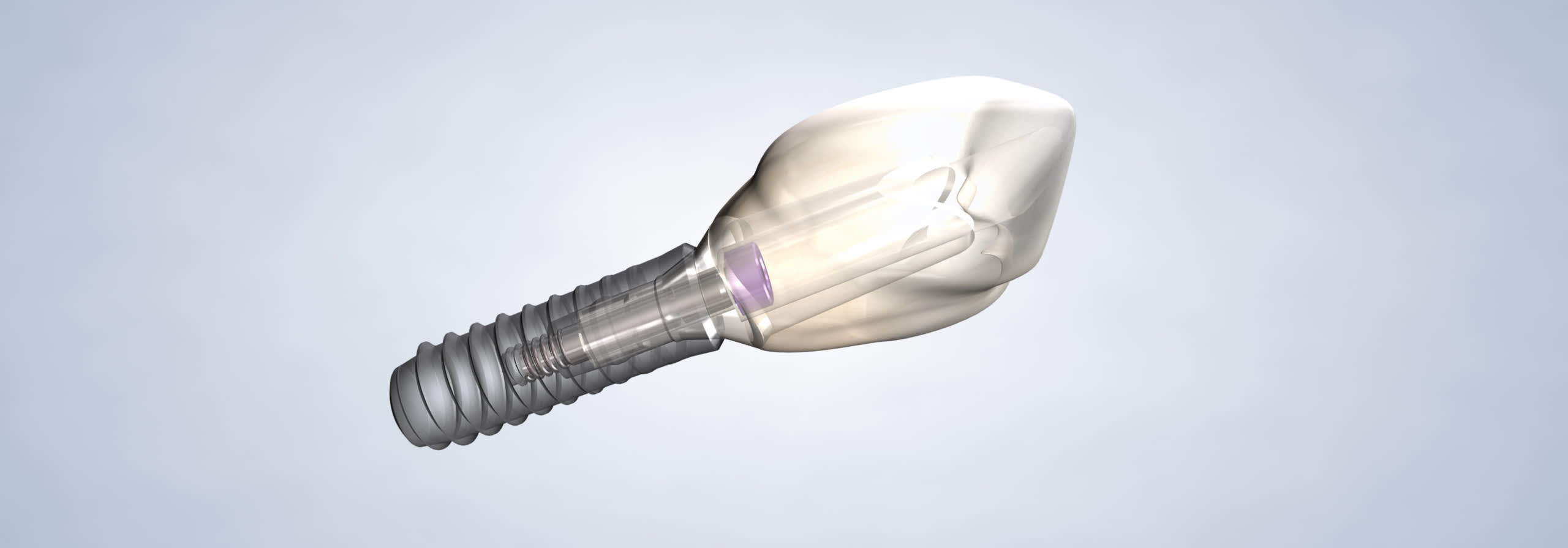 dental implants surgery in aliso viejo, CA