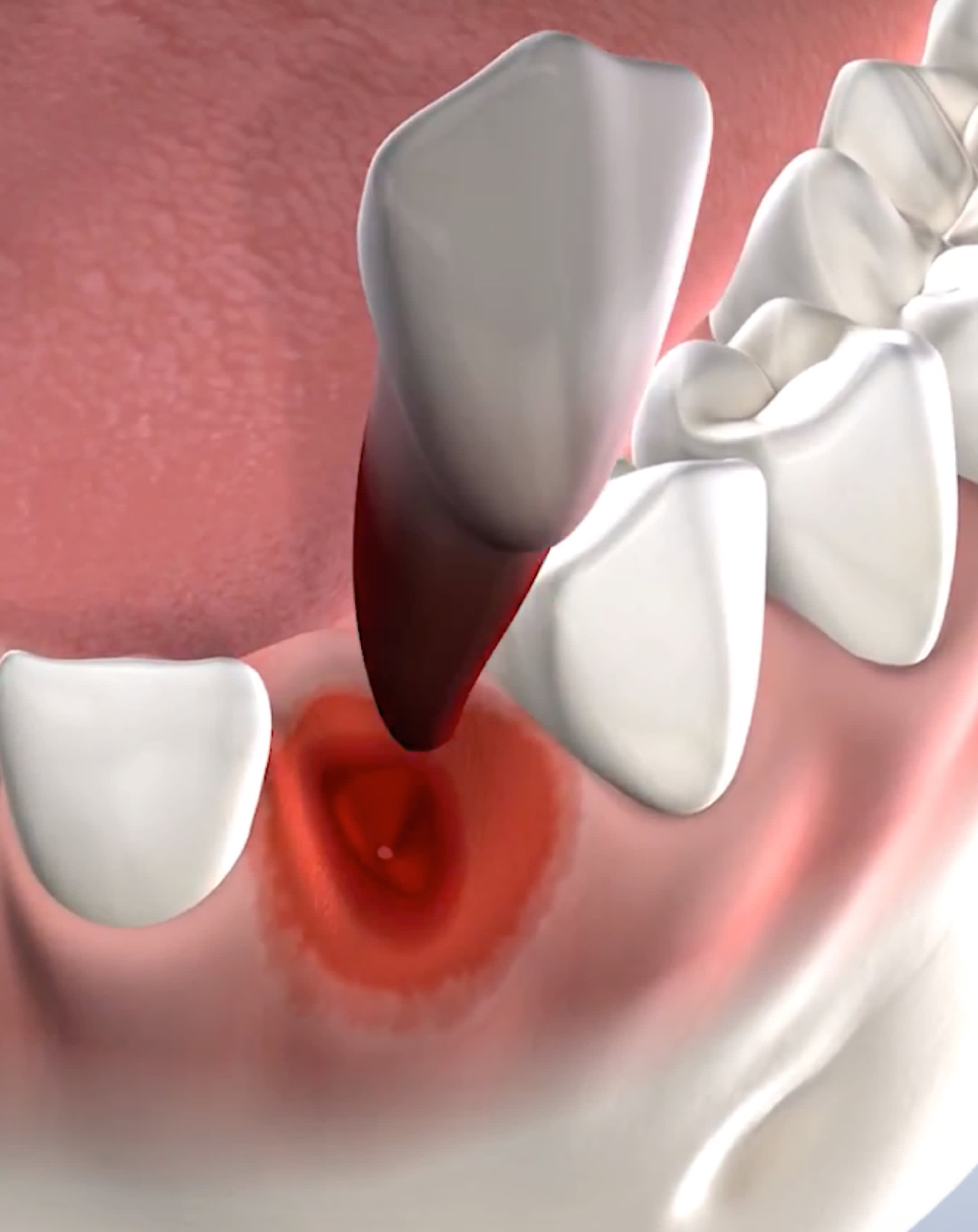 Tooth extraction procedure mobile